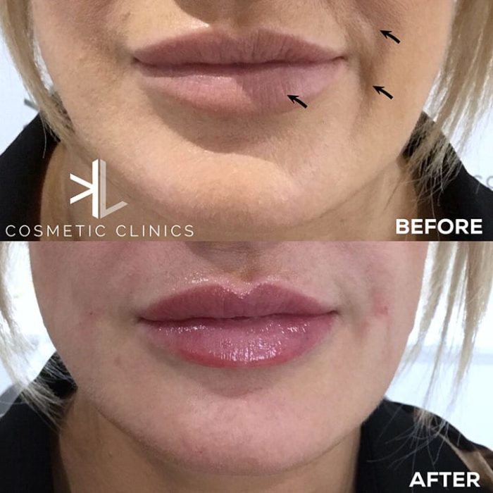 lip augmentation and Nasolabial folds