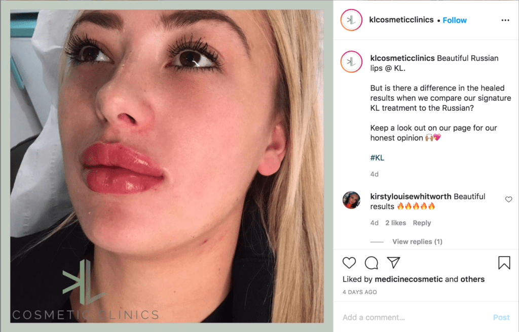 Russian lip filler technique