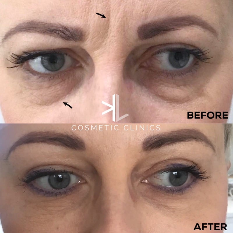 Tired eye treatment tear trough fillers Doncaster