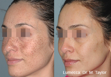 lumecca IPL pigmentation hyperpigmentation treatment Doncaster