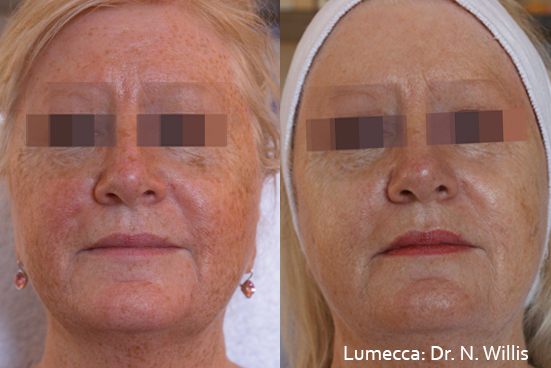 lumecca pigmentation hyperpigmentation treatment Doncaster