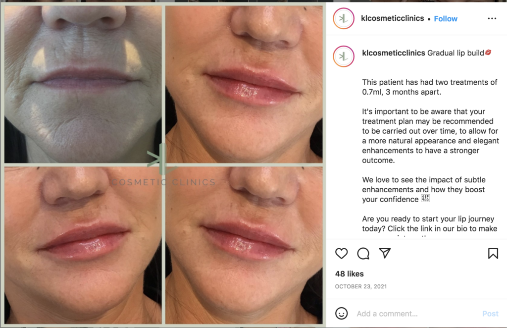 lip filler swelling and build up process KL Cosmetic Clinics Doncaster